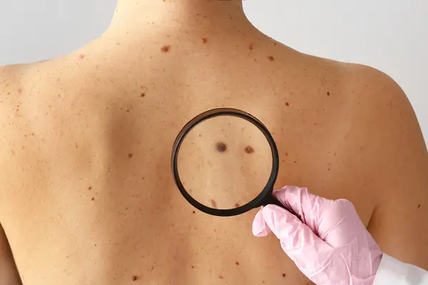 Melanoma