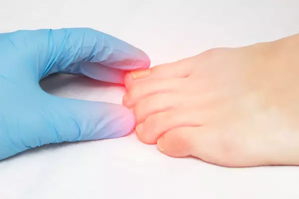 Eingewachsener Zehennagel