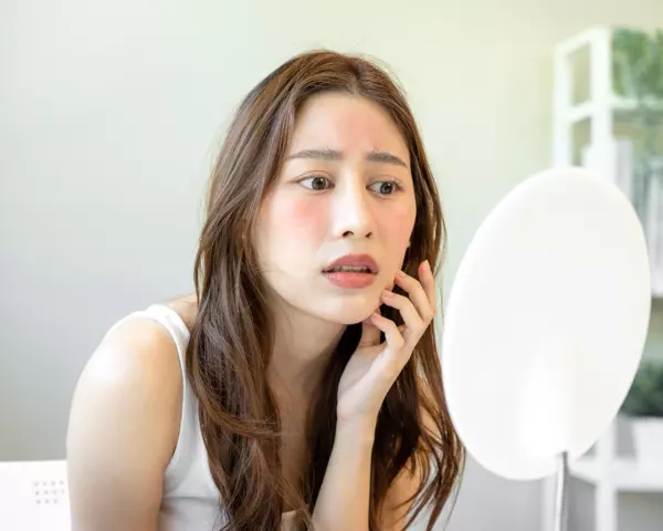 Lichtdermatose