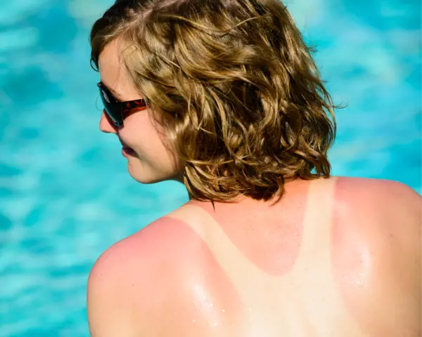 Sonnenbrand