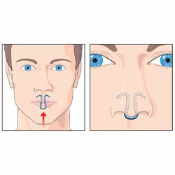 ClipAir dilatateur nasal S/M/L contre les ronflements et la congestion nasale