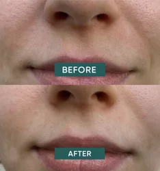 Apricot pansements bouche hyaluron keep smiling