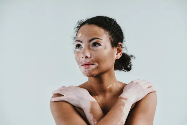 Vitiligo
