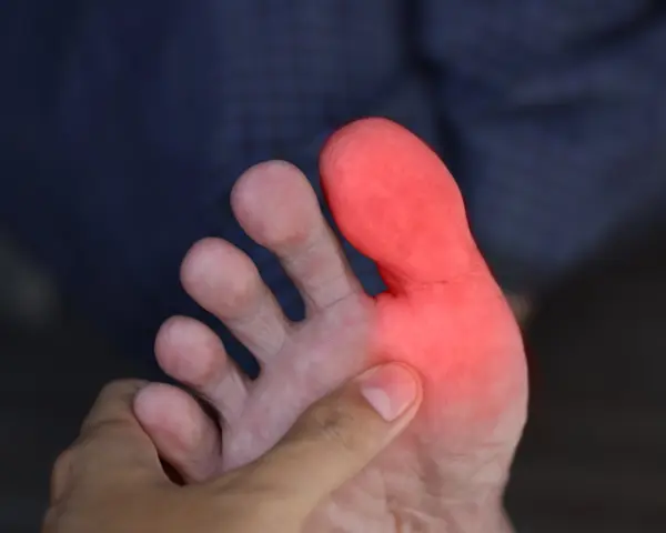 Gout