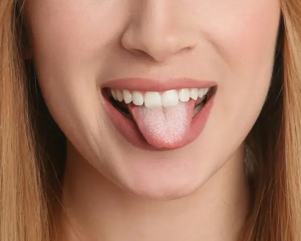 Oral thrush
